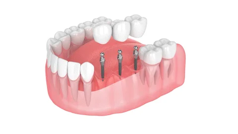 Dental implant bridge illustration showing multiple implants supporting a seamless row of natural-looking teeth, representing advanced dental solutions at Ivory Dental Implant Center in Utah.