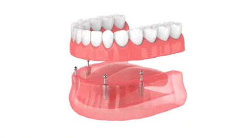 3D illustration of dental implant procedure showing a full set of permanent teeth and underlying implant structure, highlighting dental solutions offered at Ivory Dental Implant Center in Utah.
