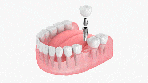 Animation of a dental implant being placed into a model jaw, illustrating the process of single dental implant restoration for missing teeth at Ivory Dental Implant Center.