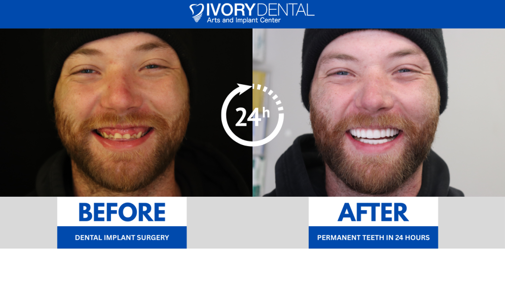 Man smiling before and after All on 4® dental implant surgery, showcasing transformation with permanent teeth in 24 hours.