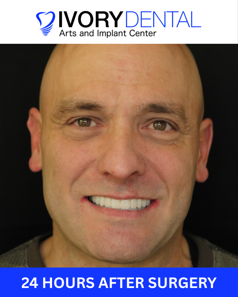Smiling man showcasing dental implants 24 hours after surgery at Ivory Dental Implant Center, highlighting successful transformation in dental care.
