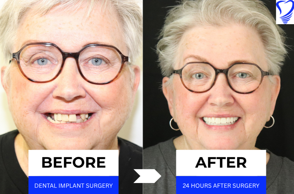 Before and after images of a female patient showing significant dental transformation with All on 4® dental implants, highlighting improved smile and confidence 24 hours post-surgery.