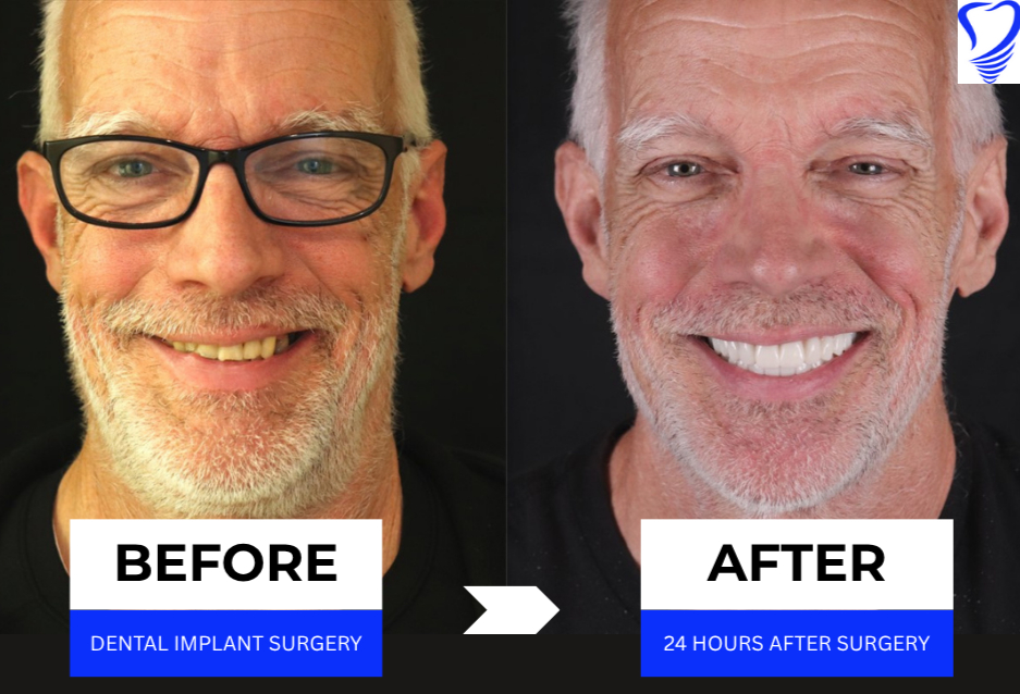 Before and after transformation of a man who underwent All on 4® dental implant surgery, showcasing significant improvement in smile and confidence, with labels indicating "BEFORE" and "AFTER."