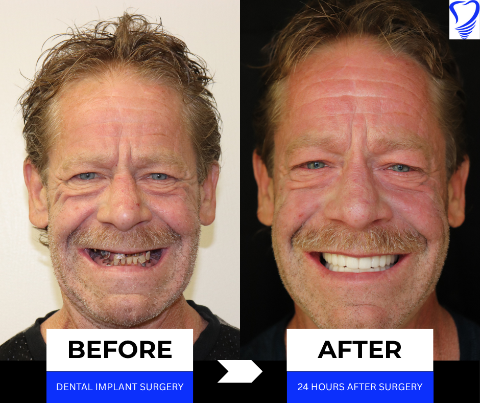 Before and after transformation of a male patient showcasing dental implant results, highlighting significant improvement in smile and facial aesthetics, with text labels indicating "Before" and "After" dental implant surgery.